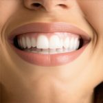 Cosmetic Dentistry: Top Tips for Faster Smile Transformations