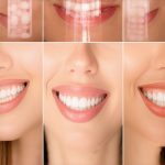 3 Veneer Alternatives Taking Over Cosmetic Dentistry in 2026