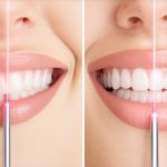 Laser vs. Traditional Teeth Cleaning: Which Wins in 2026?