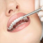 Teeth Cleaning: Effective Tips to Accelerate Results & Boost Confidence