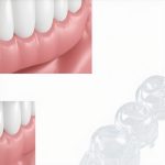 3 New 2026 Invisalign 'Bite-Pressure' Fixes for Faster Tracking