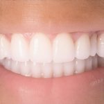 3 Signs Your Invisalign Trays Aren't Seating Right in 2026