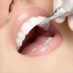 4 Reasons Your 2026 Deep Cleaning Now Includes Air Polishing