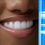 Why Your 2026 Invisalign Plan Needs Smart Pressure Sensors