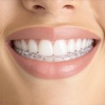 Why Your 2026 Invisalign Trays Bounce: 5 Hacks to Improve Fit