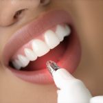 Why Your 2026 Teeth Cleaning Now Uses Infrared Tartar Detection