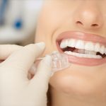 3 Ways to Fix Invisalign 'Heel-Lift' and Reseat Trays in 2026