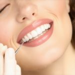 3 Ways to Stop Invisalign Enamel Wear Using 2026 Bio-Foams