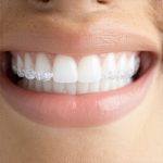 4 Ways to Fix Stubborn Invisalign Tracking Issues in 2026