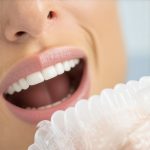 Stop Invisalign 'Edge-Lift': 3 Ways to Improve 2026 Tray Fit