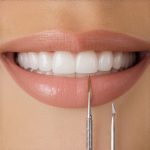 3 Ways to Stop 2026 Invisalign Lip-Catch Without Filing