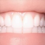 Why 2026 Nano-Resin Bonding Is Better Than Traditional Veneers