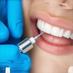Why 2026 Teeth Cleanings Now Require an Enamel-Hardening Seal